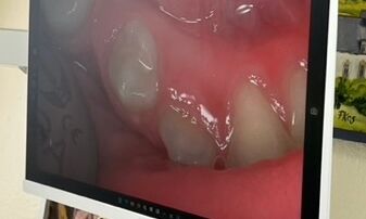 Zähne auf einem Vergrößerungsbildschirm